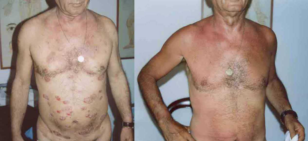 Psoriasis a Placche Addome Pancia cura naturale