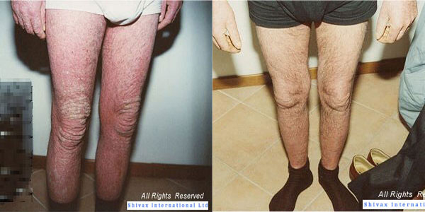 Psoriasis Cuidados para piernas y rodillas después del tratamiento